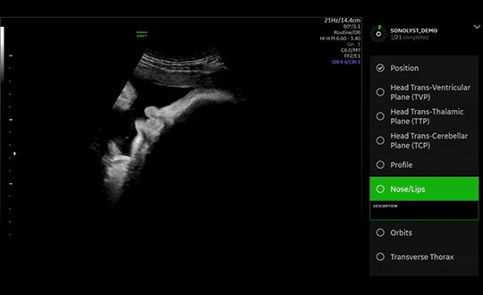 GE Healthcare SonoLyst Technology
