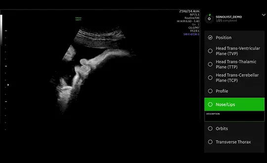 GE Healthcare SonoLyst Technology
