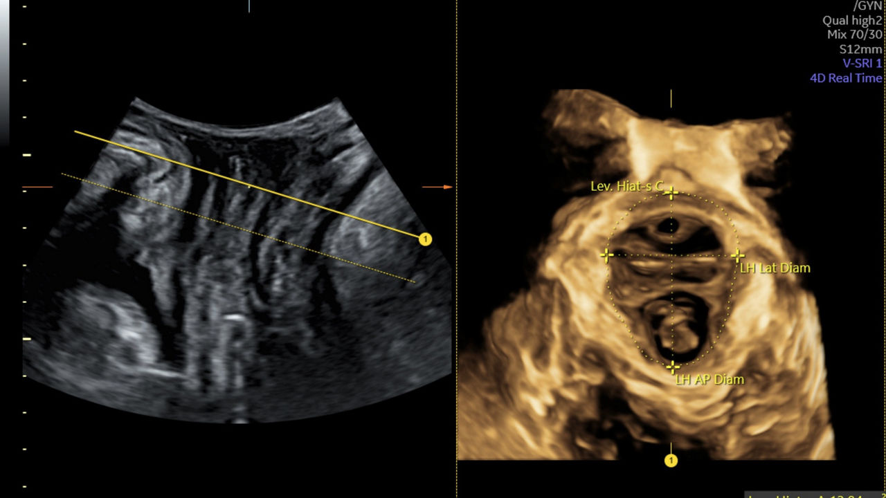 sonopelvicfloor-volusonexpert-20-image-ci-en