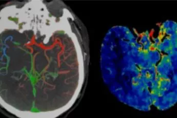 Specialties - stroke solutions