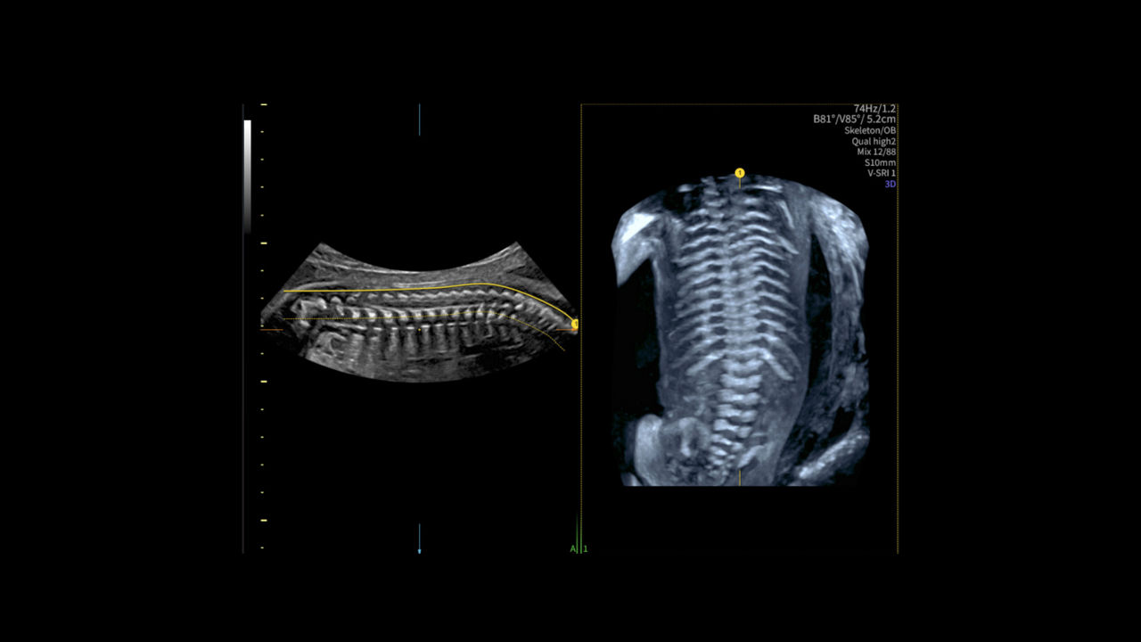 spine_trace