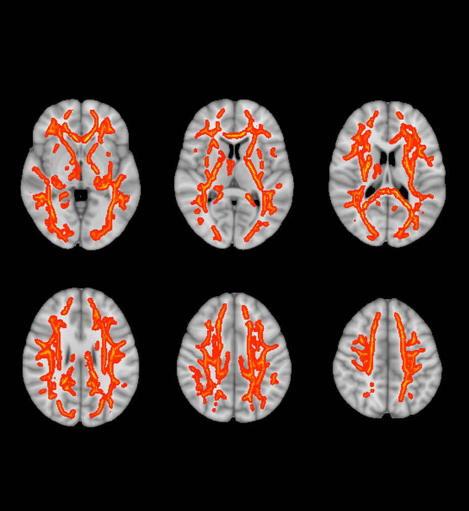 Sports-Medicine-Imaging-Concussion-and-mtbi-imaging