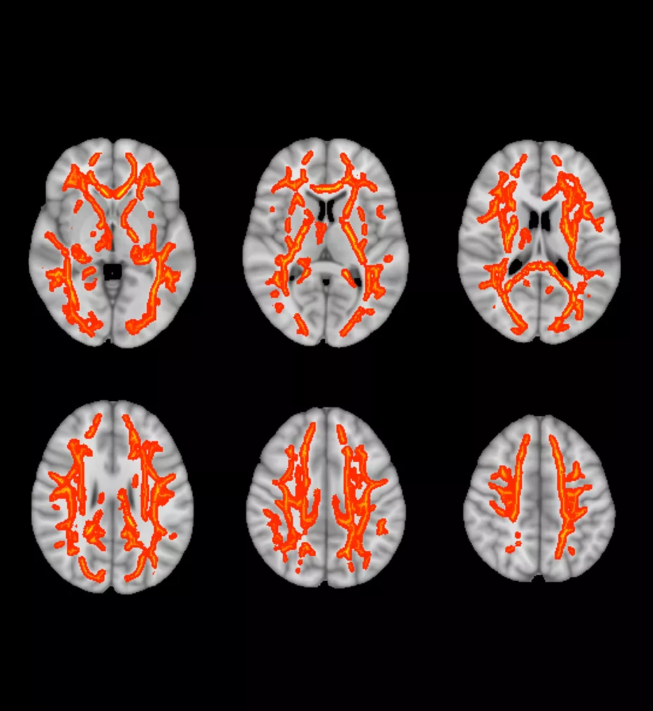 Sports-Medicine-Imaging-Concussion-and-mtbi-imaging