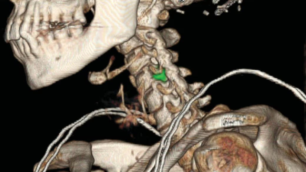 03-RelatedContent-Counting-on-hybrid-SPECT-CT