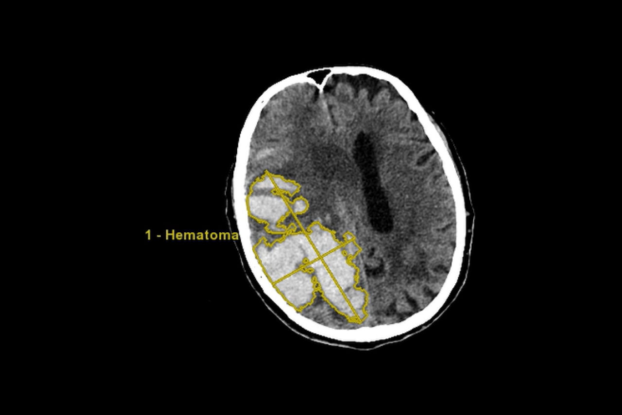 stroke-vcar-desktop-ci-en