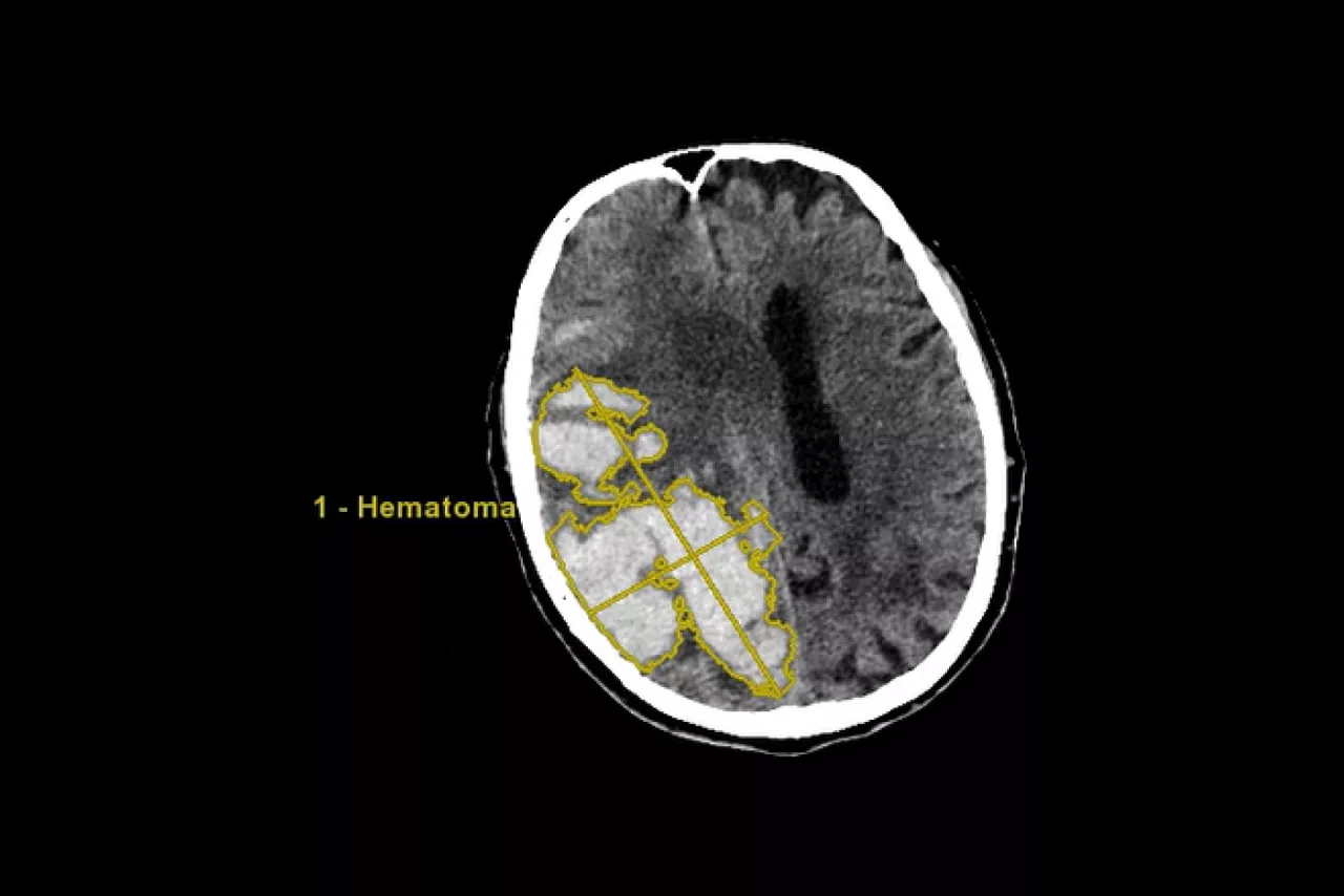 stroke-vcar-desktop-ci-en