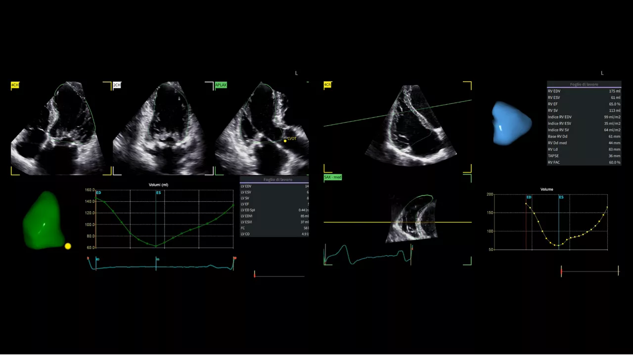 <p>Advanced 4D transthoracic echocardiography for accurate assessment of tricuspid regurgitation</p>
