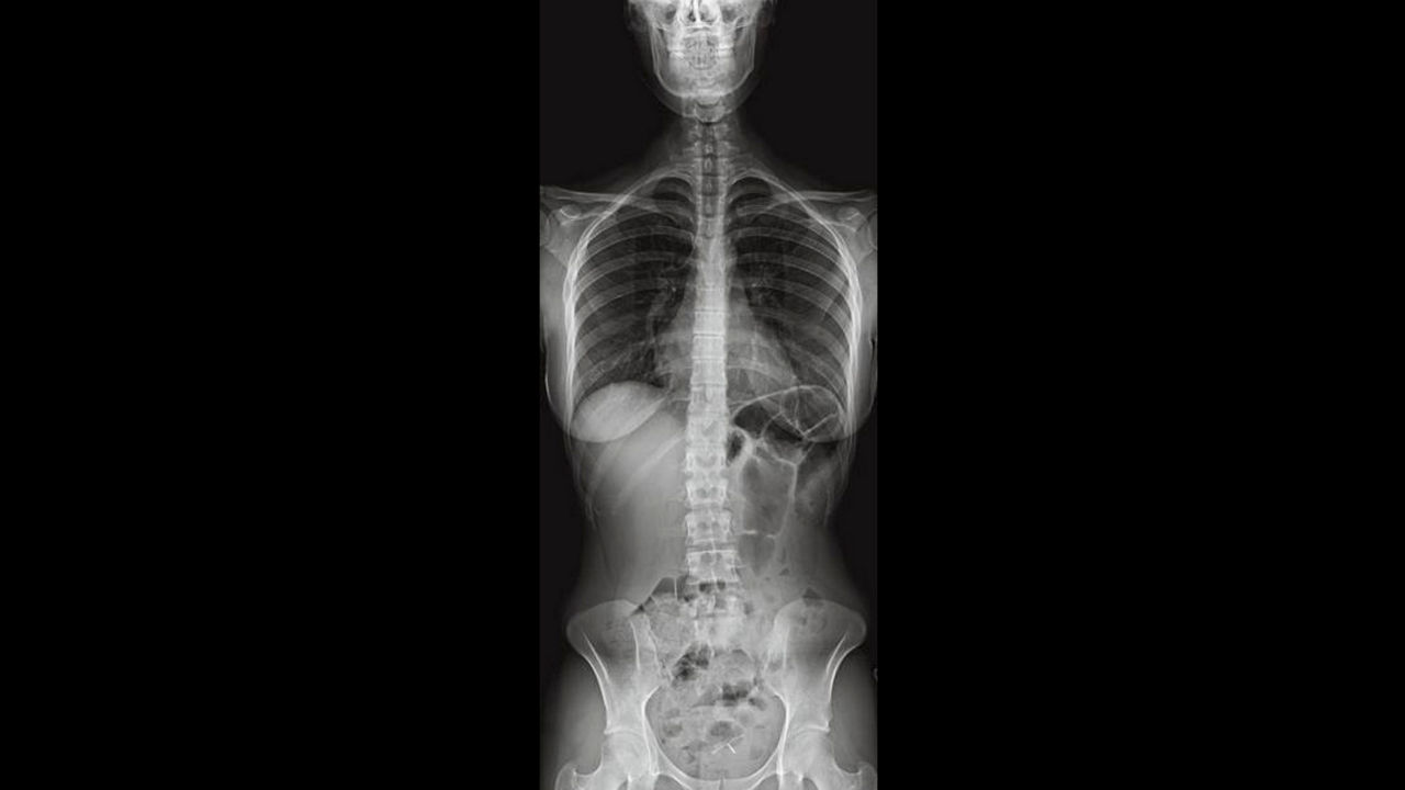 Image of an X-ray of a female torso using Auto Image Paste.