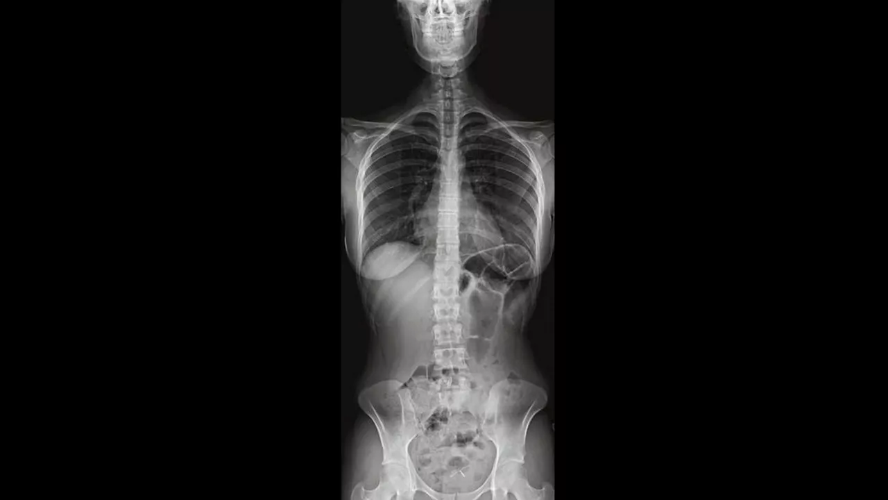 Image of an X-ray of a female torso using Auto Image Paste.