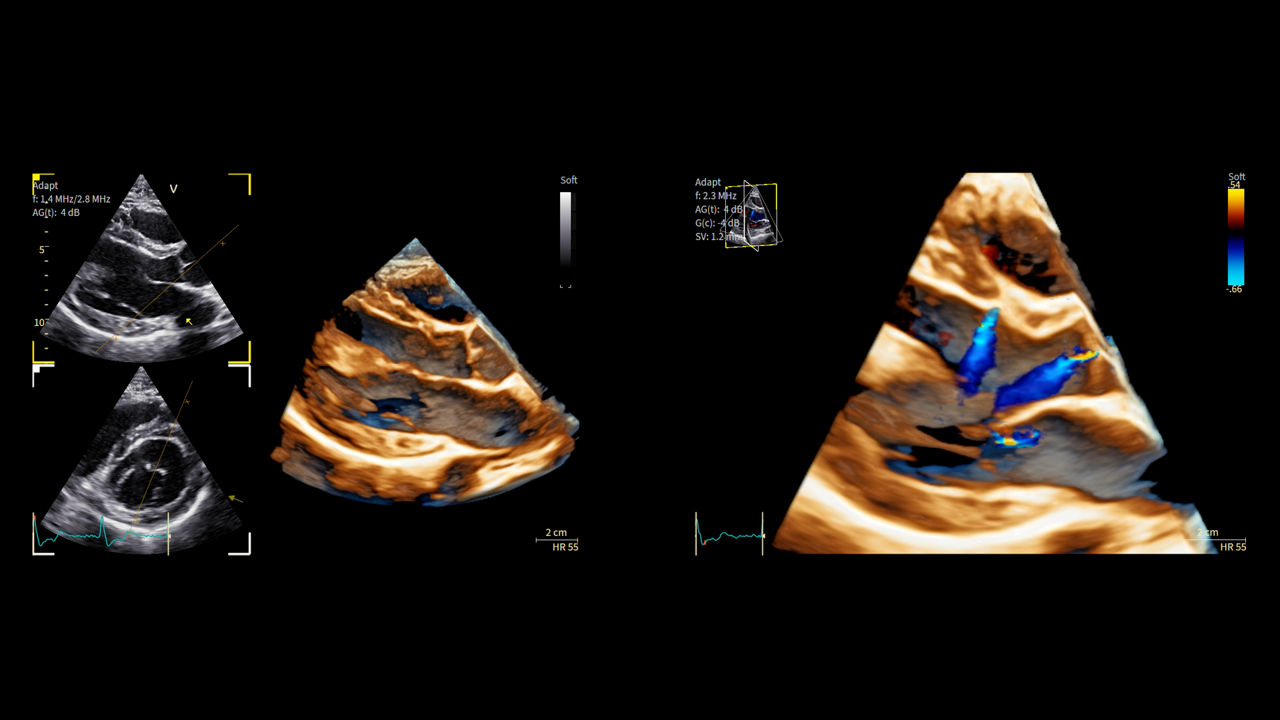 <p>Advancements in imaging of Hypertrophic Cardiomyopathy</p>
