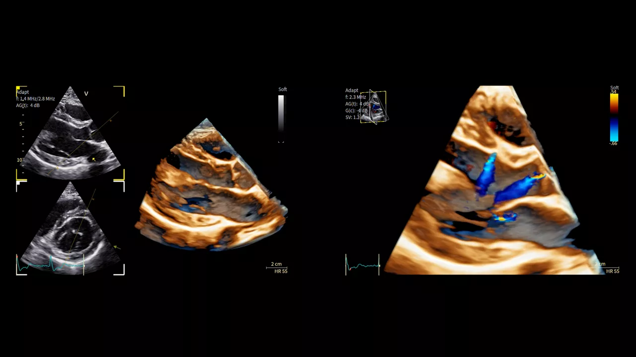 <p>Advancements in imaging of Hypertrophic Cardiomyopathy</p>
