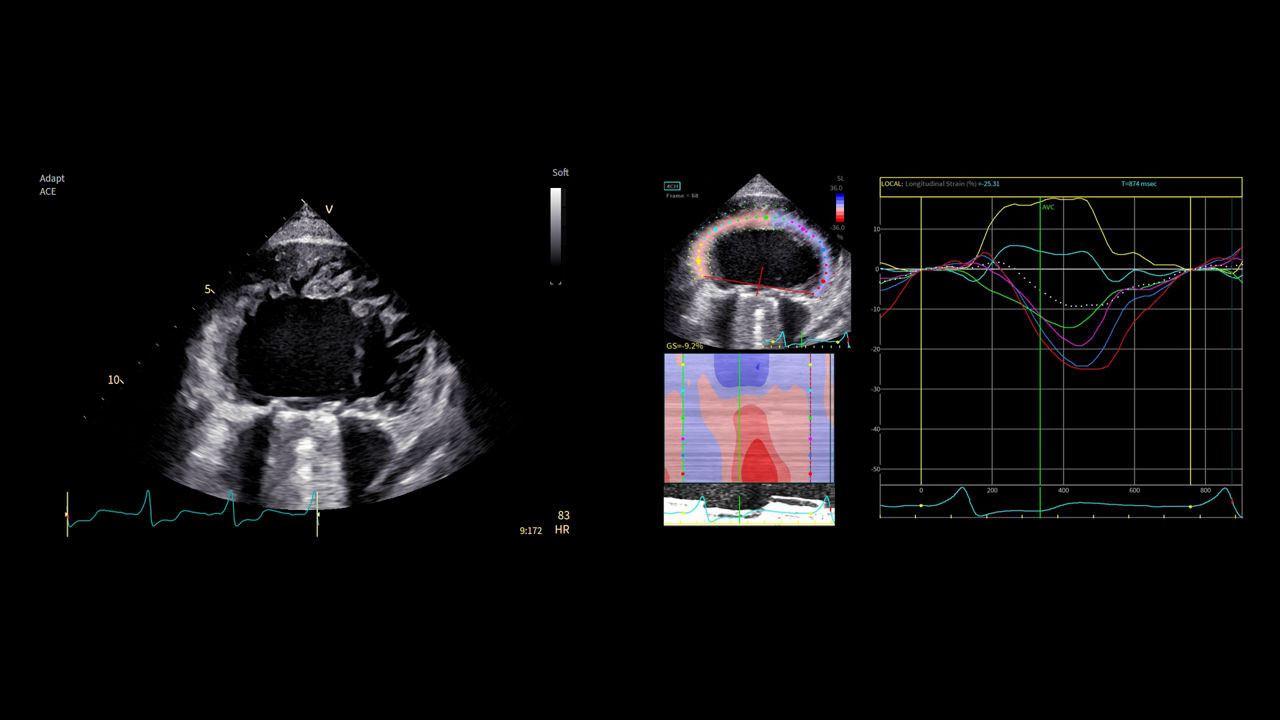 <p>Case study: Precise imaging in severe cardiomegaly with single ventricle</p>
