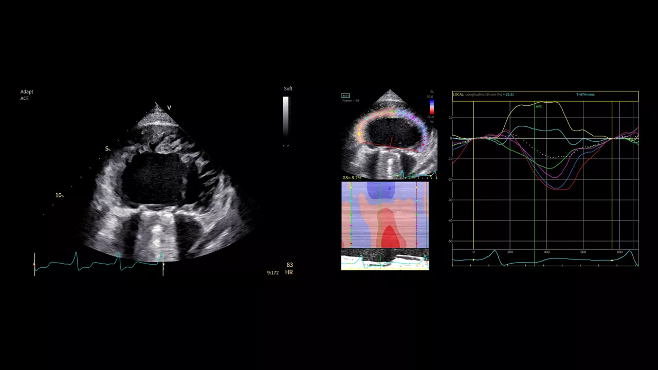 <p>Case study: Precise imaging in severe cardiomegaly with single ventricle</p>

