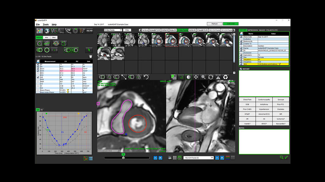 suiteHEART1040-x-585