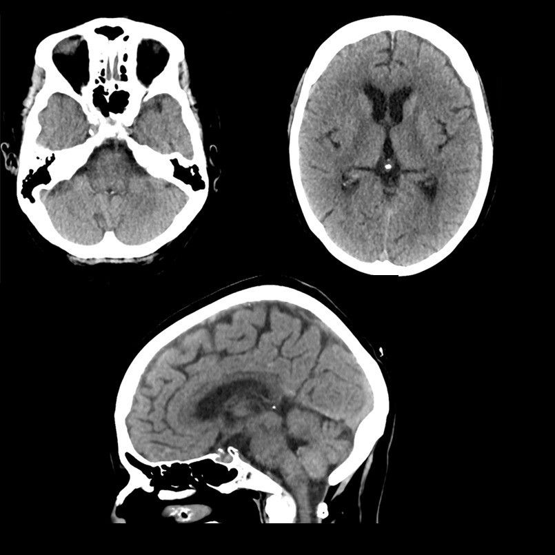 t-categories-computed-tomography-revolution ct-clinical images-neurology-routine brain.jpg