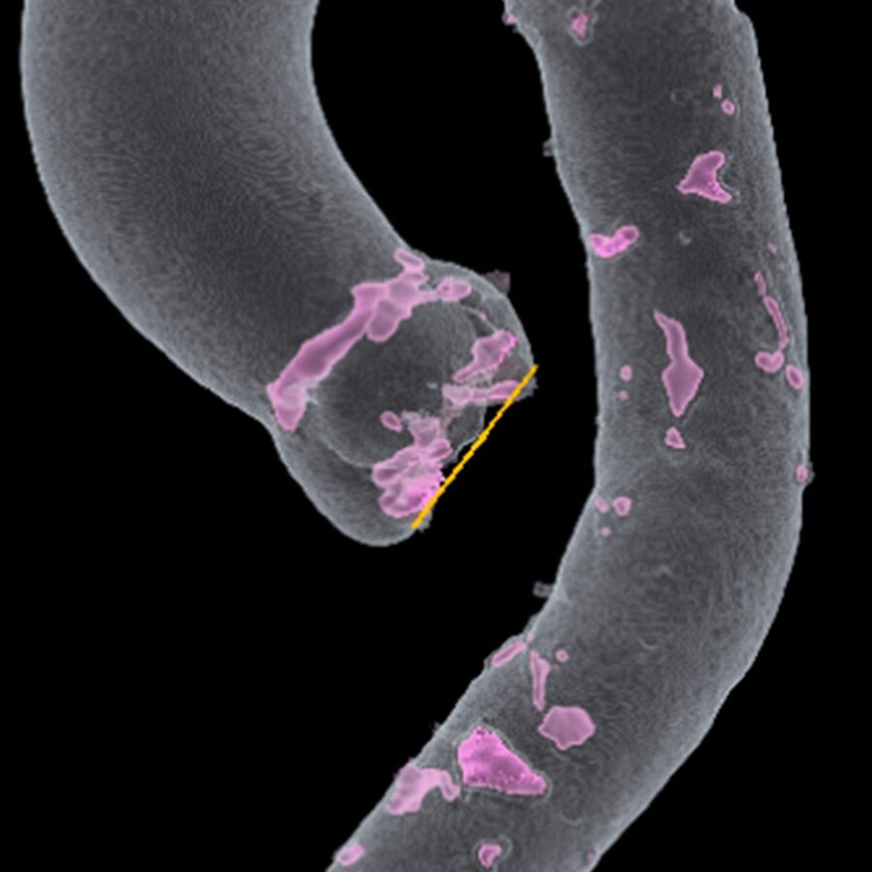 tavi-assess-aortic-root-670x670