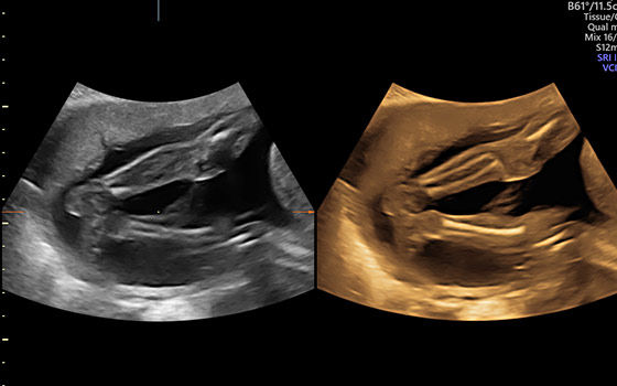 Volume Contrast Imaging (VCI)