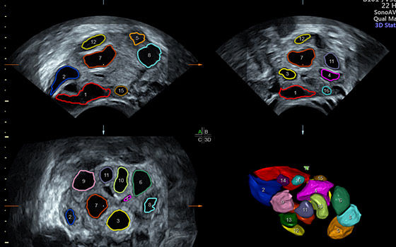 SonoAVC™follicle & SonoAVC antral