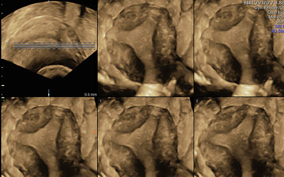 Tomographic Ultrasound Imaging (TUI)