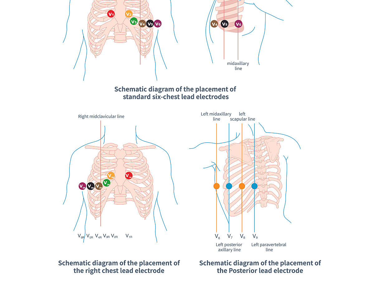 the-chest-electrode-of-e