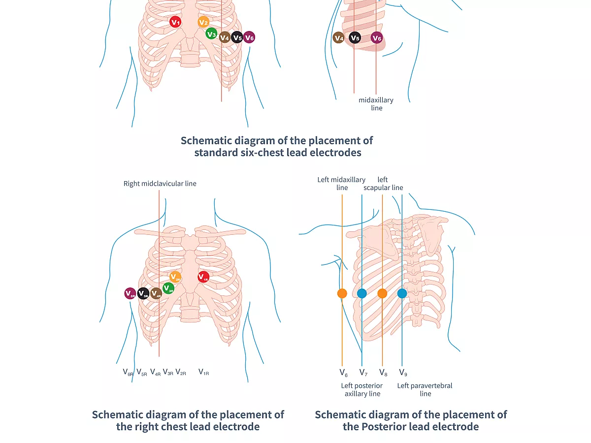 the-chest-electrode-of-e