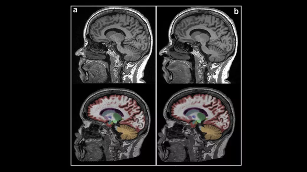 Therapeutics-for-Alzheimers-Disease