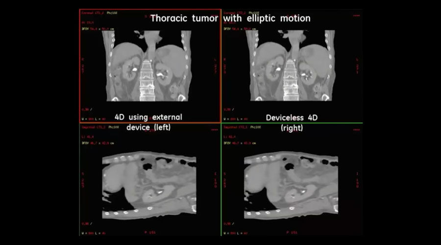 Thoracic tumor with elliptic motion