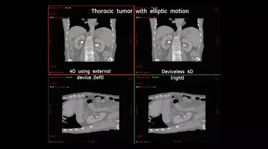 Thoracic-tumor-with-elliptic-motion