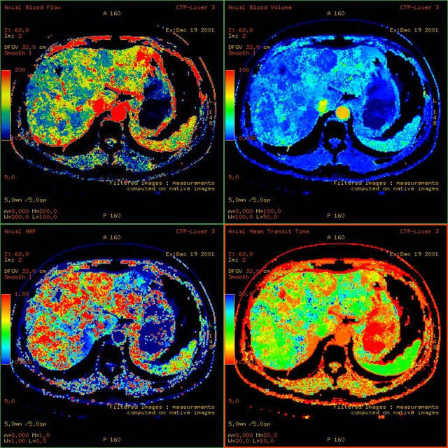 tion-applications-ct-perfusion-4d-multi-organs-aw-ct-perfusion-4d-multi-organ_overview.jpg