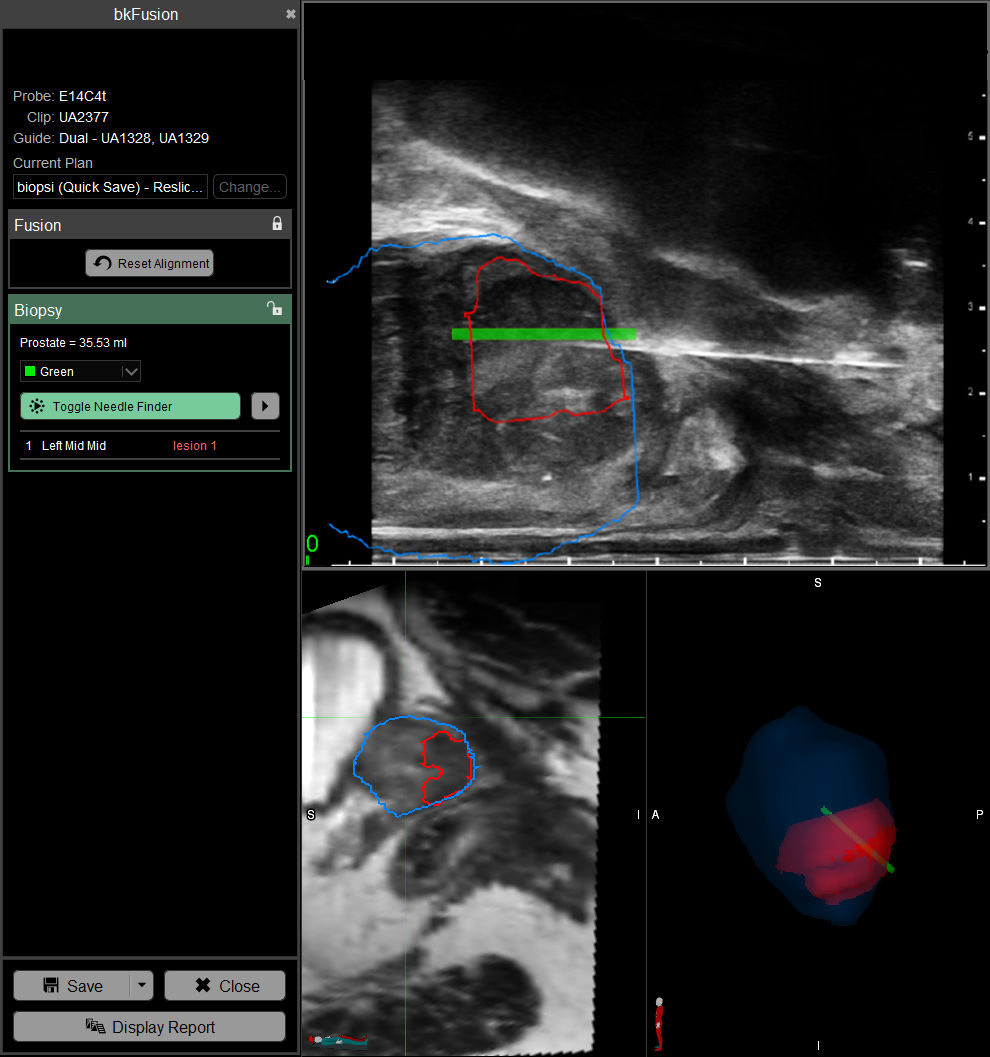 Transperineal freehand targeted fusion biopsy_2