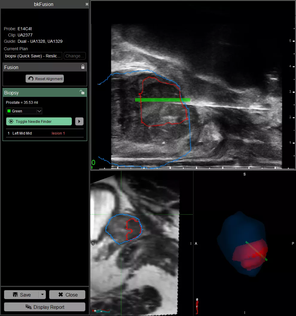 Transperineal freehand targeted fusion biopsy_2