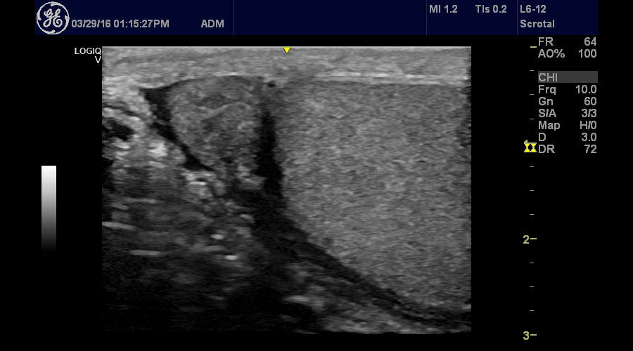 ultrasound-logiq-v2-saggital-testicle-image-using-logiq-v2