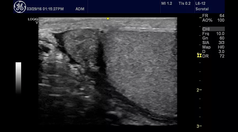 ultrasound-logiq-v2-saggital-testicle-image-using-logiq-v2