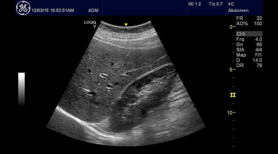 ultrasound-logiq-v2-sagittal-right-kidney--logiq-v2