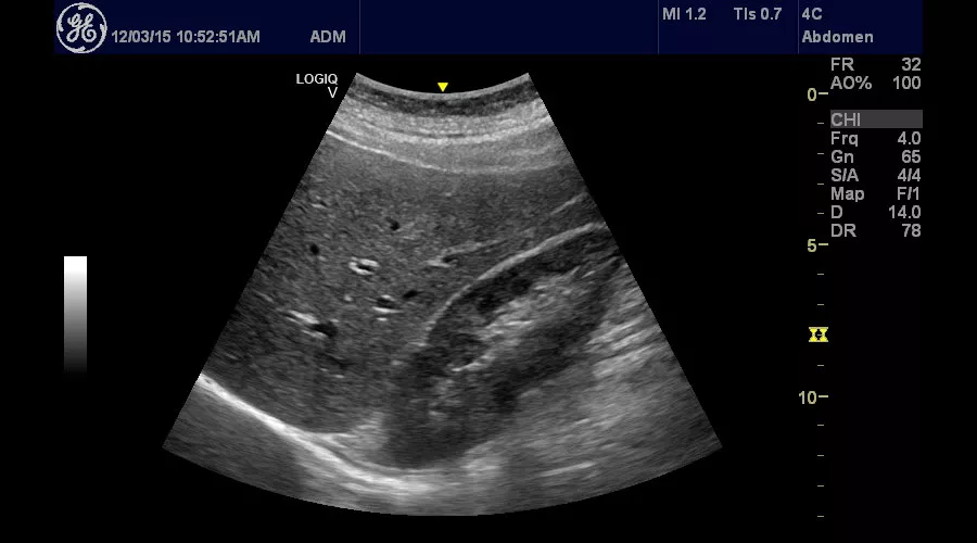 ultrasound-logiq-v2-sagittal-right-kidney--logiq-v2