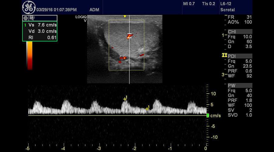 ultrasound-logiq-v2-testical-pulse-wave-doppler-logiq-v2