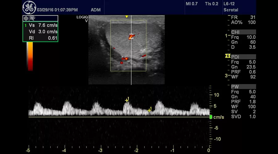 ultrasound-logiq-v2-testical-pulse-wave-doppler-logiq-v2