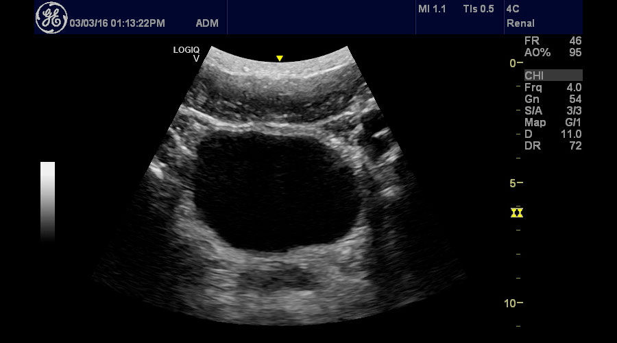 ultrasound-logiq-v2-transverse-bladder-using-logiq-v2