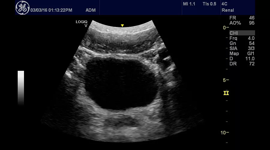 ultrasound-logiq-v2-transverse-bladder-using-logiq-v2