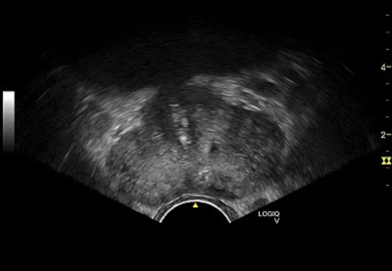 ultrasound-logiq-v2-transverseprostate