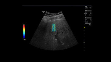 ultrasound-shear wave