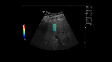 ultrasound-shear wave