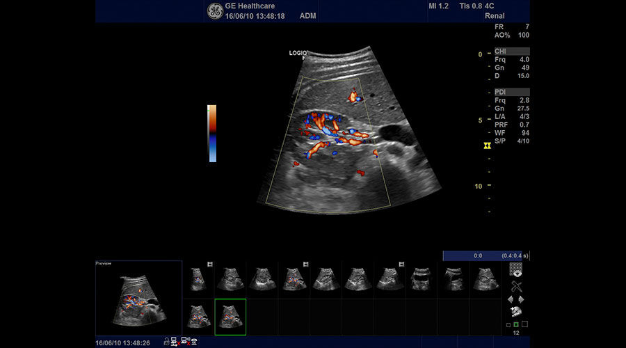 ultrasound-urology-logiq-f8-transverse-kidney