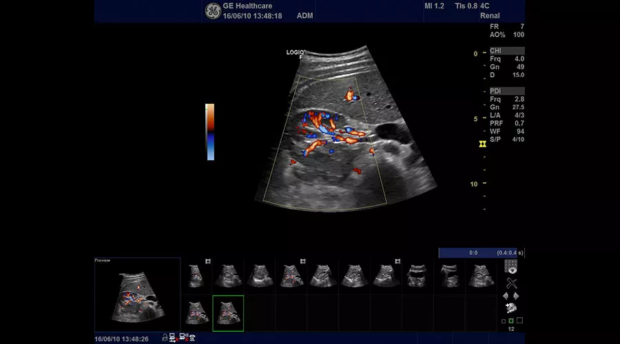 ultrasound-urology-logiq-f8-transverse-kidney