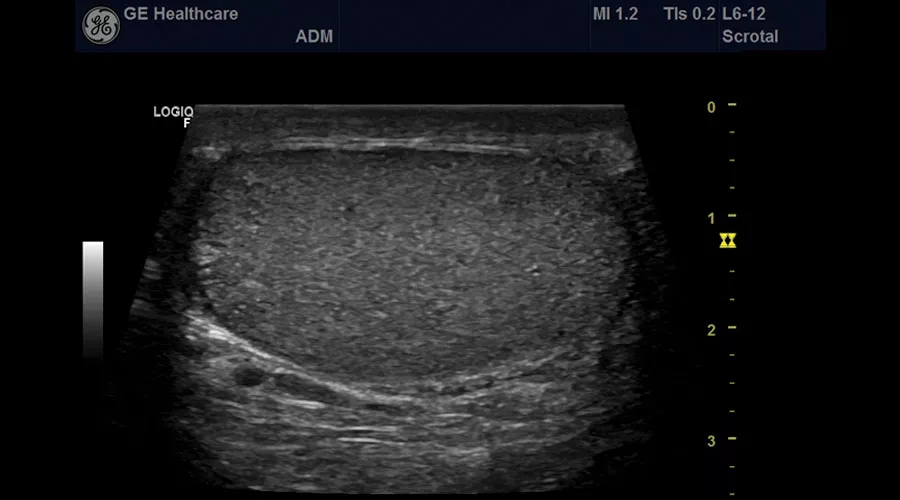 ultrasound-urology-sagittal-testicle