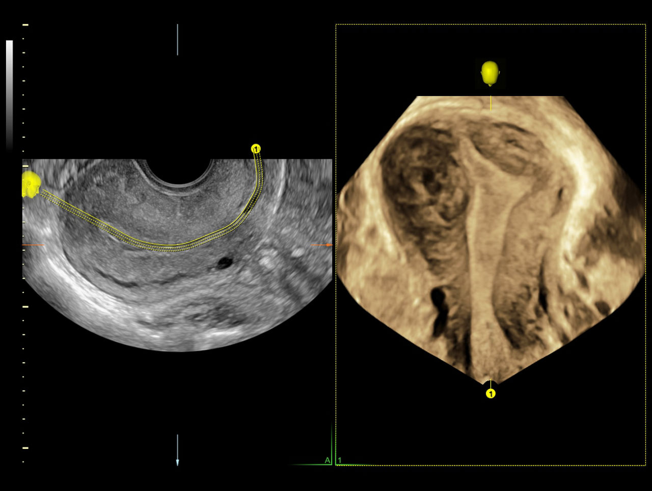 uterine-trace-1-ci-en