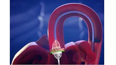 Valve Assist 2_new