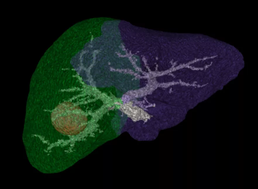 vanced-visualization-applications-hepatic-vcar-image-gallery-aw-hepatic-vcar-hvcar-vr1_jpg