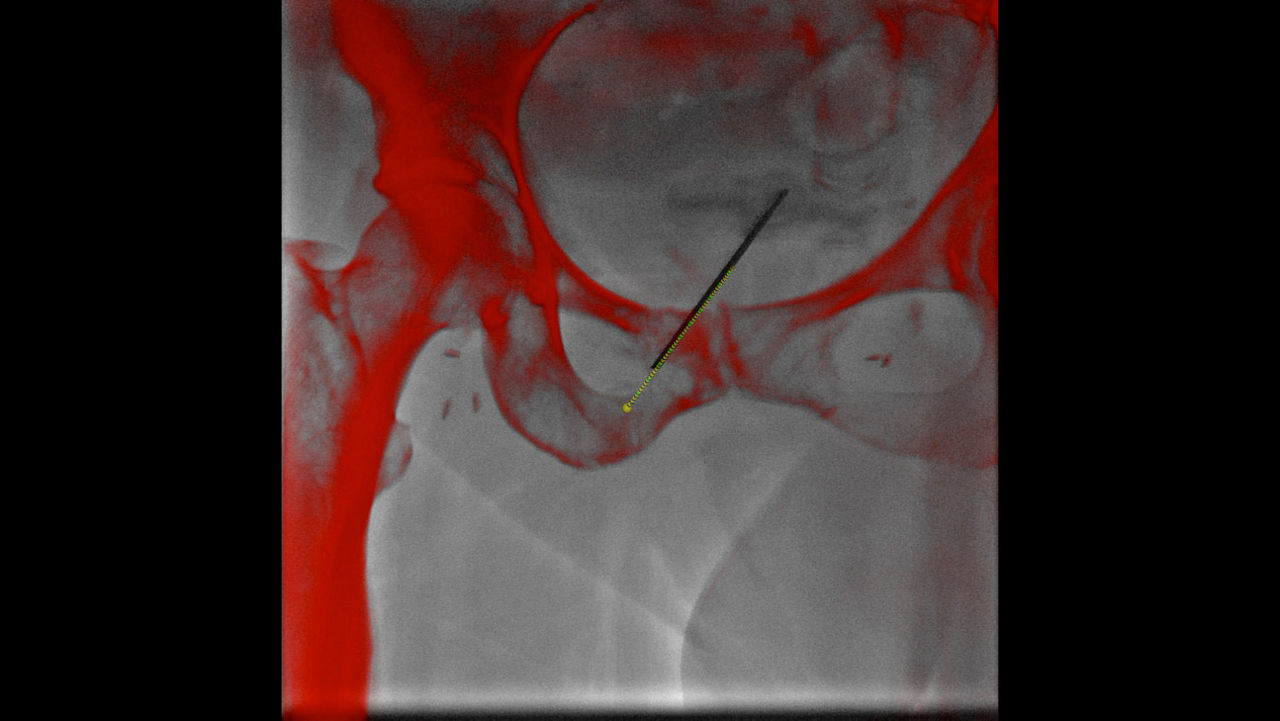 vanced-visualization-applications-innova-trackvision-clinical-aw-trackvision-clinical4