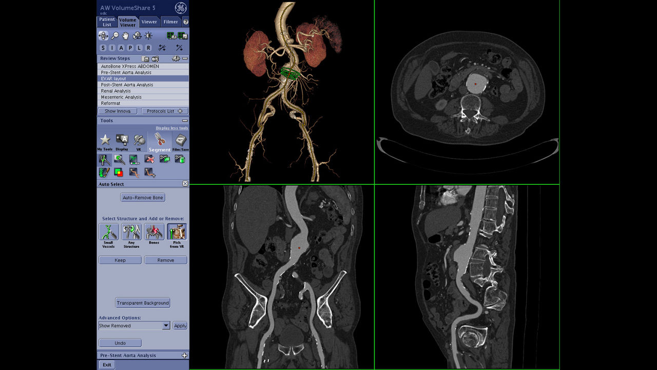vanced-visualization-applications-tevar-assist-image-gallery-aw-tevar-assist-clinical1
